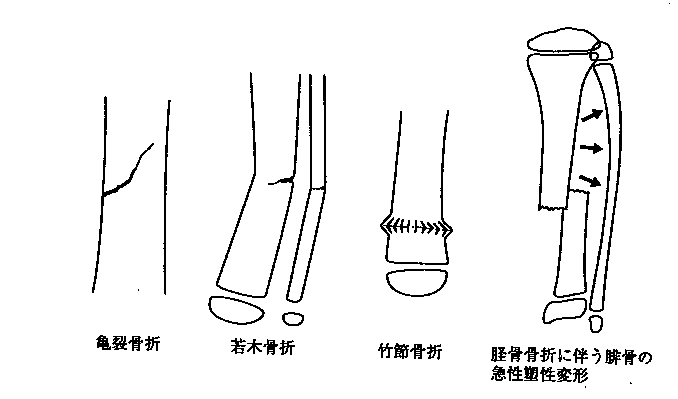 脱臼 骨折の治療 整体信玄 整骨院信玄 山梨県甲府市に2店舗 甲府徳行店 甲府和戸店 ギックリ腰 肩 首の辛さにお勧め